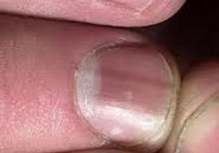 Если ногти растут волнами: причины и лечение